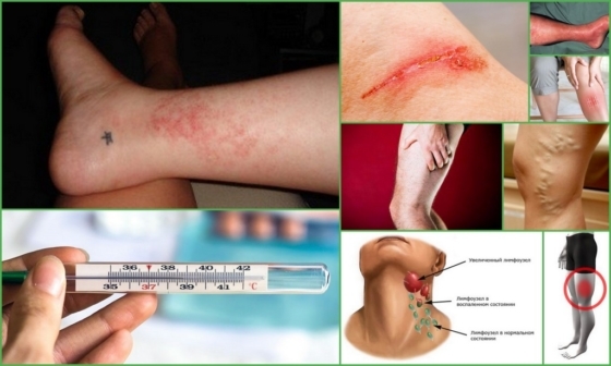 Постинъекционный флебит: лечение