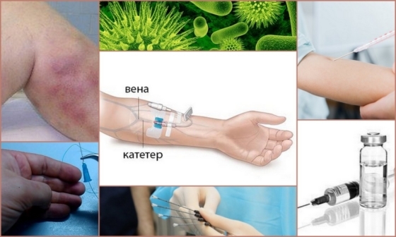Постинъекционный флебит: лечение
