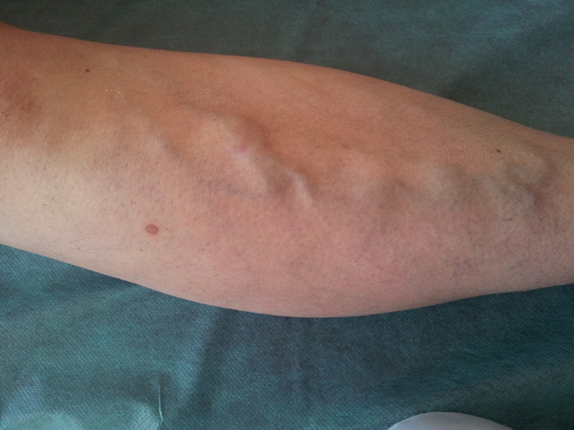 Постинъекционный флебит: лечение