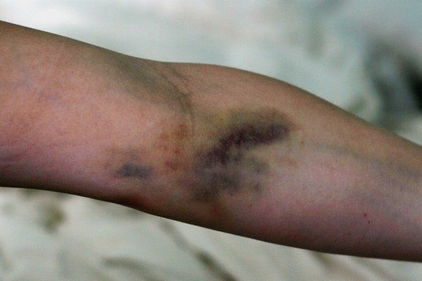 Постинъекционный флебит: лечение