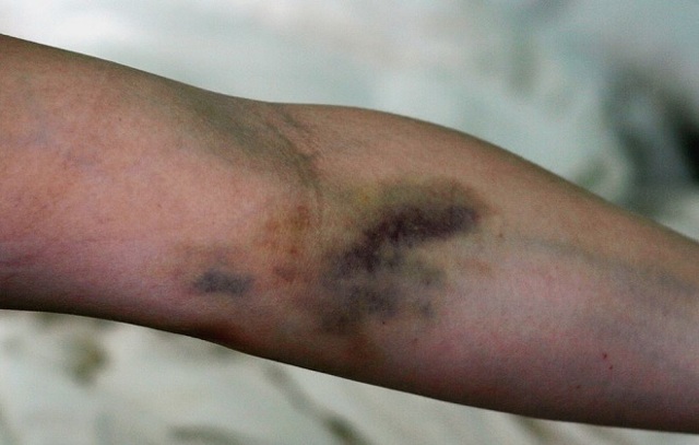 Постинъекционный флебит: лечение