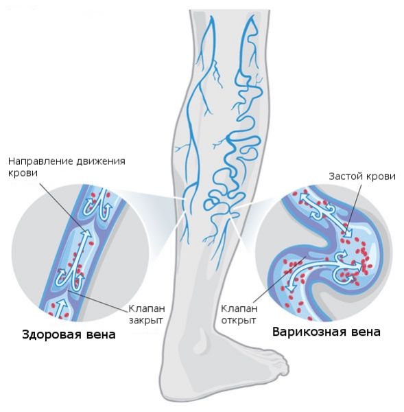 Прадакса и венарус: что лучше и в чем разница (отличие составов, отзывы врачей)