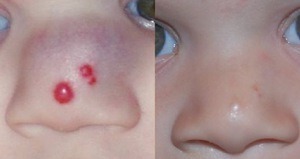 Причины гемангиомы у взрослых в печени, на позвоночнике, коже