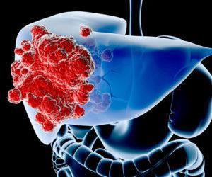 Причины гемангиомы у взрослых в печени, на позвоночнике, коже