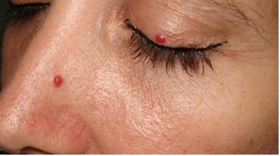 Причины гемангиомы у взрослых в печени, на позвоночнике, коже