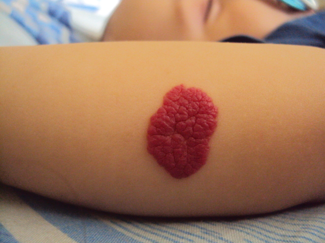 Причины гемангиомы у взрослых в печени, на позвоночнике, коже