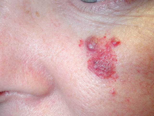 Причины гемангиомы у взрослых в печени, на позвоночнике, коже