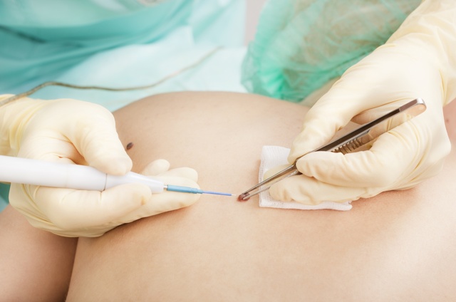 Причины гемангиомы у взрослых в печени, на позвоночнике, коже