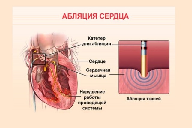 Радиочастотная абляция (рча) и внутривенная лазерная абляция (evla)
