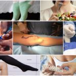 Реабилитация после операции на варикоз нижних конечностей: что можно и нельзя делать после операции, стационарное и домашнее восстановление