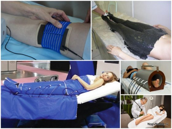 Реабилитация после операции на варикоз нижних конечностей: что можно и нельзя делать после операции, стационарное и домашнее восстановление