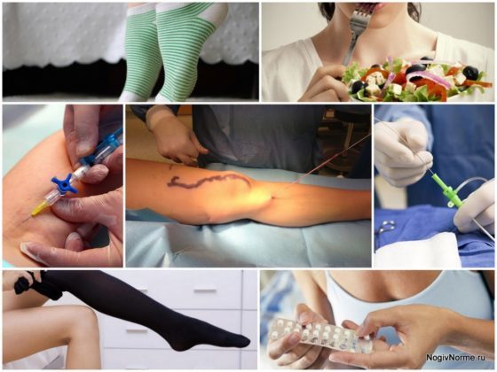 Реабилитация после операции на варикоз нижних конечностей: что можно и нельзя делать после операции, стационарное и домашнее восстановление