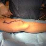 Реабилитация после операции на варикоз нижних конечностей: что можно и нельзя делать после операции, стационарное и домашнее восстановление