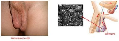 Рецидив варикоцеле после операции: признаки, причины, лечение, профилактика