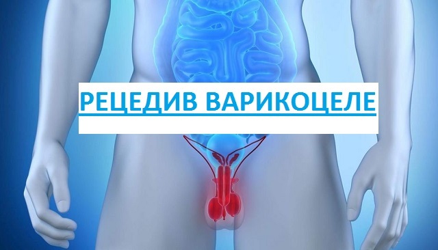 Рецидив варикоцеле после операции: признаки, причины, лечение, профилактика