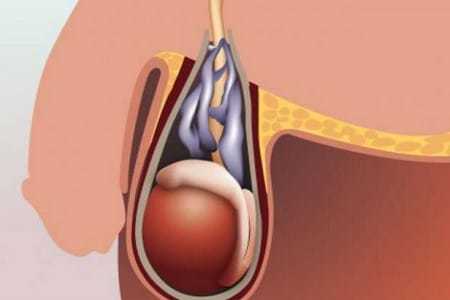 Рецидив варикоцеле после операции: признаки, причины, лечение, профилактика