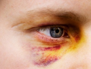 Статья за побои: что будет, УК РФ 115, избиение несовершеннолетнего ребенка, статья за драку, групповое избиение, ответственность