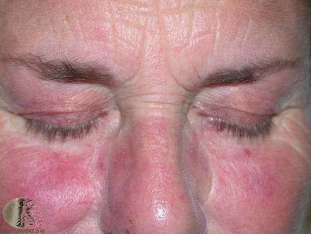 Стероидная розацеа: лечение