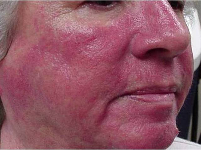 Стероидная розацеа: лечение