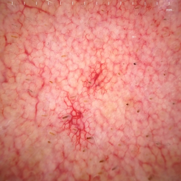 Стероидная розацеа: лечение