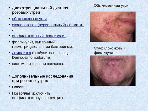 Стероидная розацеа: лечение