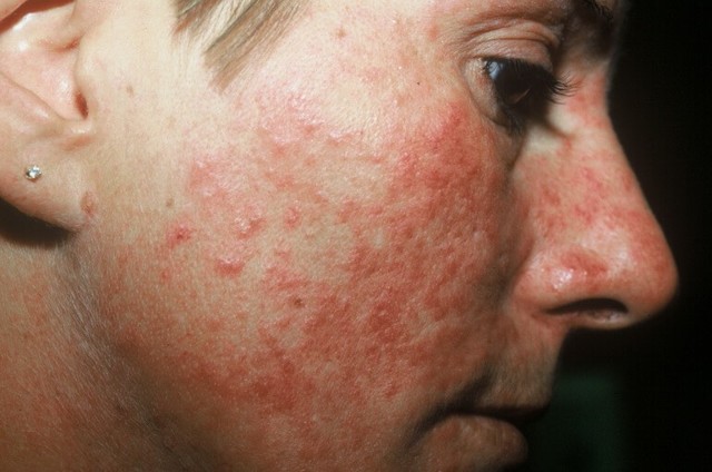 Стероидная розацеа: лечение