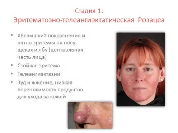 Стероидная розацеа: лечение