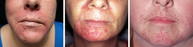 Стероидная розацеа: лечение