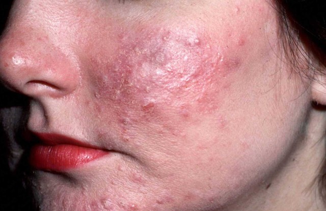 Стероидная розацеа: лечение