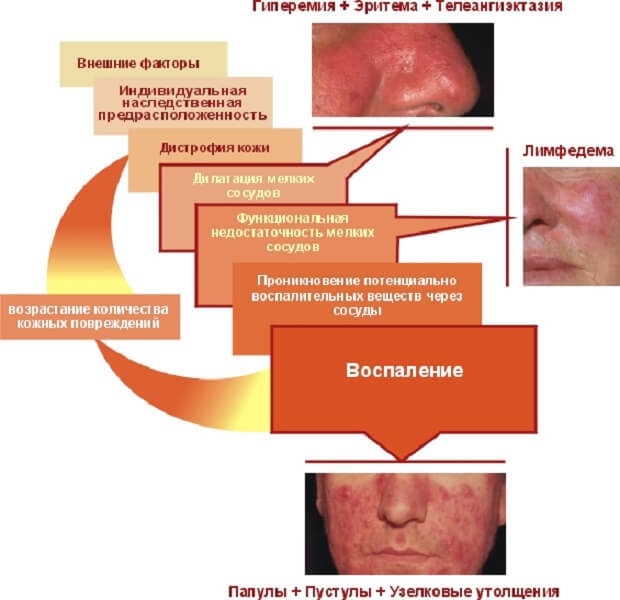 Стероидная розацеа: лечение