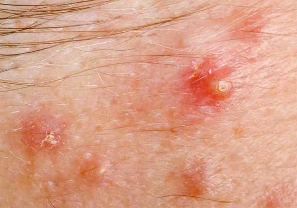 Стероидная розацеа: лечение