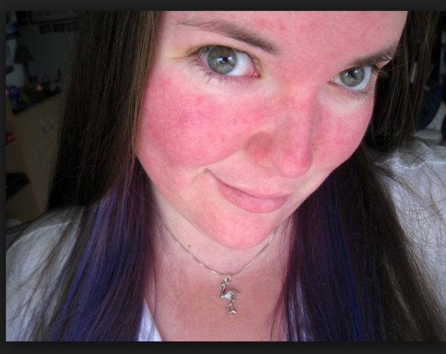 Стероидная розацеа: лечение