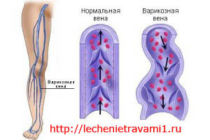 Травы при варикозе: каштан, доник, крапива, каланхоэ, софора японская, бессмертник, одуванчик, тысячелистник, ромашка