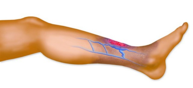 Троксерутин и конский каштан – можно ли принимать одновременно (совместимость)