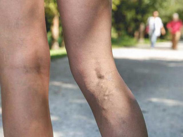 Троксерутин и конский каштан – можно ли принимать одновременно (совместимость)