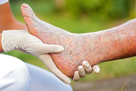 Троксерутин и конский каштан – можно ли принимать одновременно (совместимость)