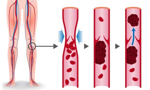 Троксевазин и тромблесс: что лучше и в чем разница (отличие составов, отзывы врачей)