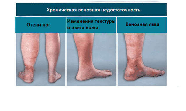 Троксевазин и венолайф: что лучше и в чем разница (отличие составов, отзывы врачей)