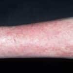 Троксевазин и венолайф: что лучше и в чем разница (отличие составов, отзывы врачей)