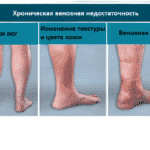 Троксевазин и венолайф: что лучше и в чем разница (отличие составов, отзывы врачей)