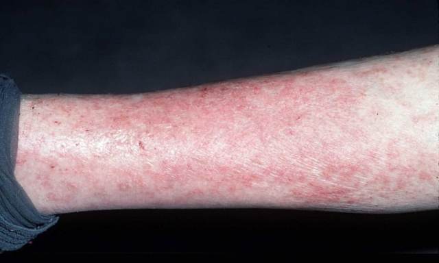 Троксевазин и венолайф: что лучше и в чем разница (отличие составов, отзывы врачей)