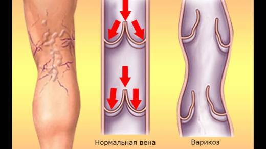 Троксевазин или флебодиа: что лучше и в чем разница (отличие составов, отзывы врачей)