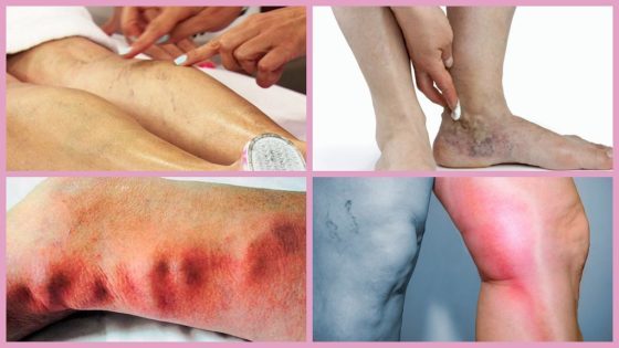 Троксевазин (мазь) при варикозе – инструкция по применению, отзывы, аналоги, форма выпуска, побочные действия, противопоказания, цена