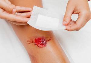 Троксевазин (мазь) при варикозе – инструкция по применению, отзывы, аналоги, форма выпуска, побочные действия, противопоказания, цена