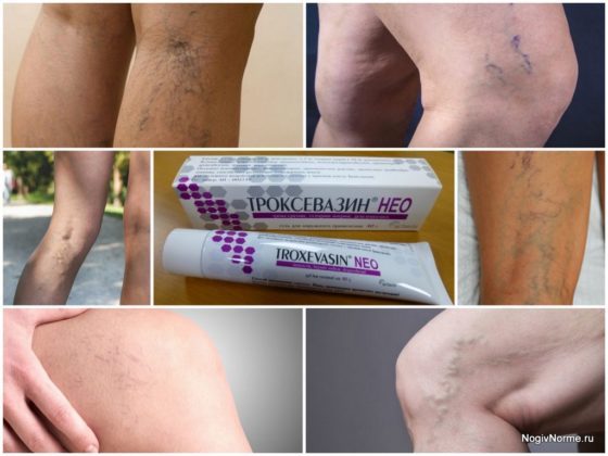 Троксевазин (мазь) при варикозе – инструкция по применению, отзывы, аналоги, форма выпуска, побочные действия, противопоказания, цена