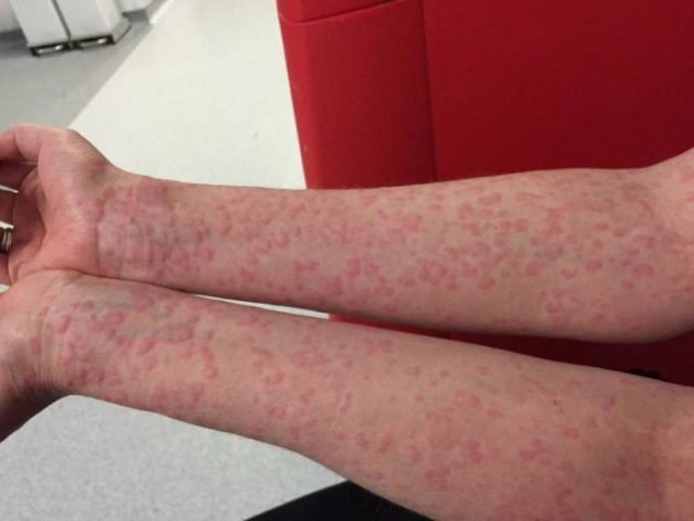 Троксевазин (мазь) при варикозе – инструкция по применению, отзывы, аналоги, форма выпуска, побочные действия, противопоказания, цена