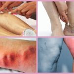 Троксевазин (мазь) при варикозе – инструкция по применению, отзывы, аналоги, форма выпуска, побочные действия, противопоказания, цена