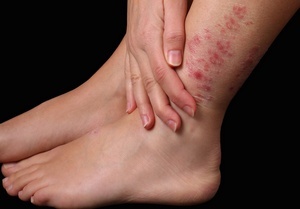 Троксевазин (мазь) при варикозе – инструкция по применению, отзывы, аналоги, форма выпуска, побочные действия, противопоказания, цена