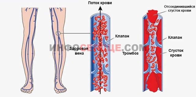 Тромбоасс или аспирин кардио: что лучше и в чем разница (отличие составов, отзывы врачей)