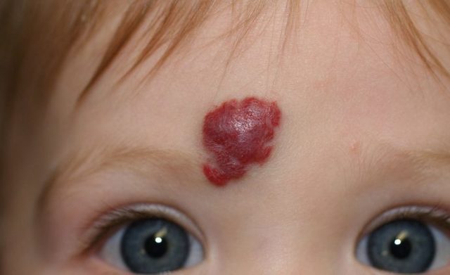 Удаление гемангиомы: лазером, скальпелем, криотерапией, электрофорезом, склеротерапией